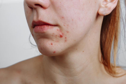 Espinhas e cravos: um guia rápido sobre eles! - Beauts